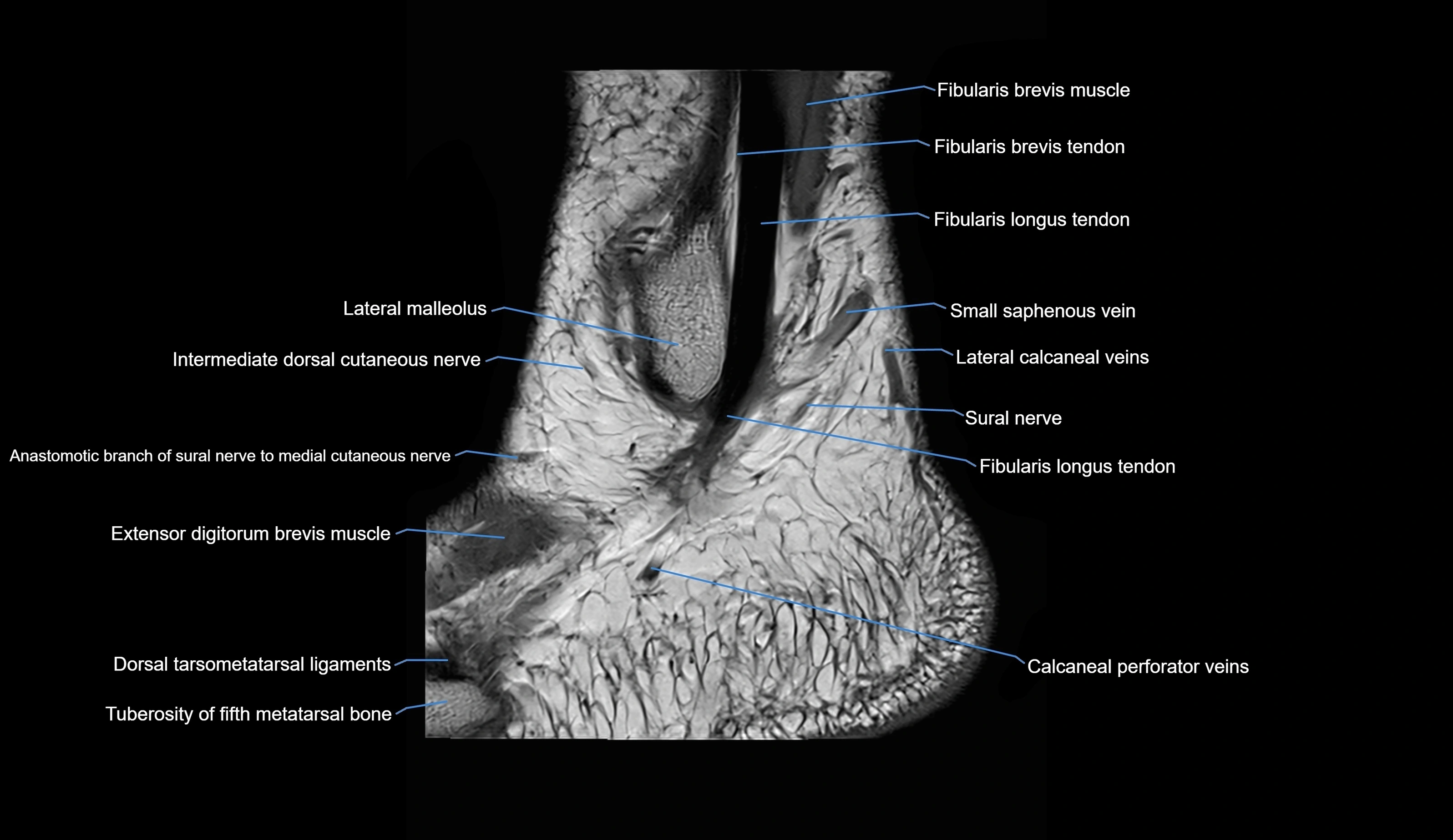 MRI Ankle sagittal cross sectional anatomy 3T  radiology  image-img-00001-00032.webp